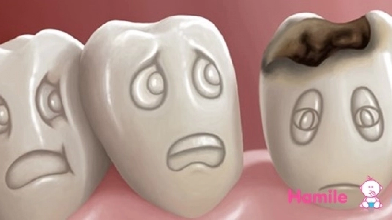 Diş çürümesi nedenleri ve tedavisi