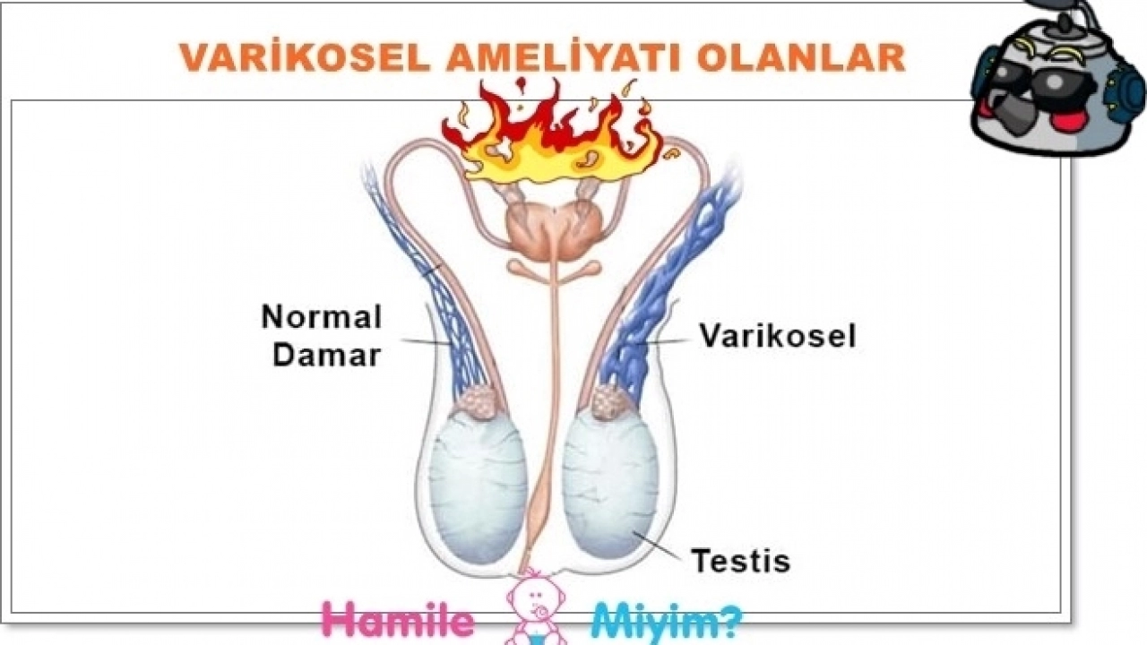 Varikosel Ameliyatı Olanlar Olacaklar Lütfen Dikkat