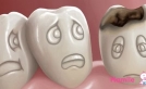 Diş çürümesi nedenleri ve tedavisi