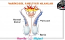 Varikosel Ameliyatı Olanlar Olacaklar Lütfen Dikkat