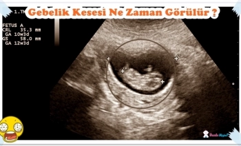 SORU: Gebelik kesesi ne zaman görülür ne zaman oluşur ?