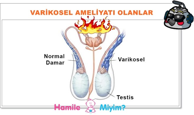 varikosel ameliyatı olanlar kadınlar kulübünde