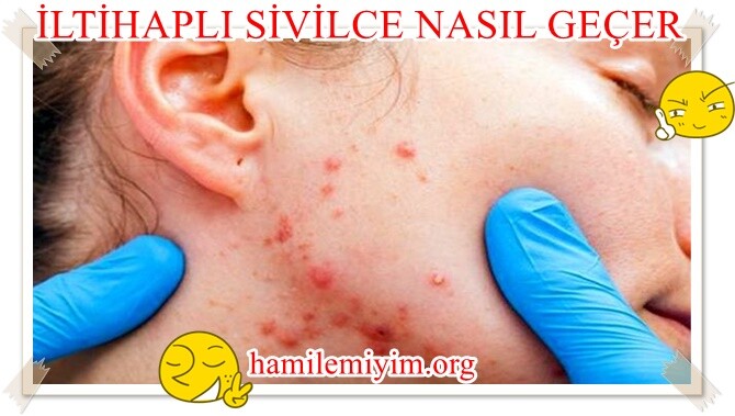 iltihaplı sivilce nasıl geçer kadınlar kulübü