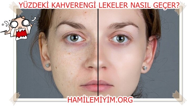 YÜZDEKİ kahverengi lekeler kadınlar kulübü
